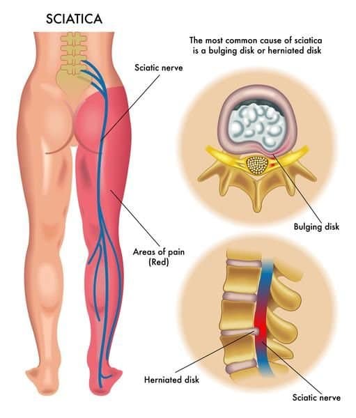 You are currently viewing Is Sciatica Making Your Life Immovable?